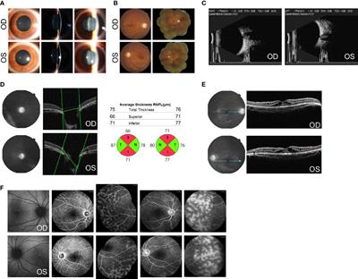 Biallelic Heterozygous Mutations in Crumbs Homolog-1 Gene Associated With Macular Retinoschisis and Angle-Closure Glaucoma: A Case Report and Literature Review